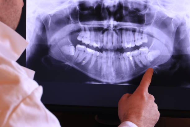Best Knocked-Out Tooth (Avulsed Tooth) Treatment in Fraser, CO
